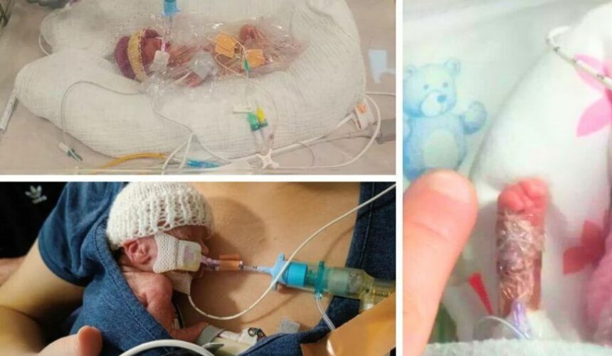 W 23 tygodniu ciąży przyszła na świat dziewczynka. Przeżyła
